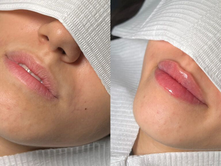0.5 ML Lip Filler