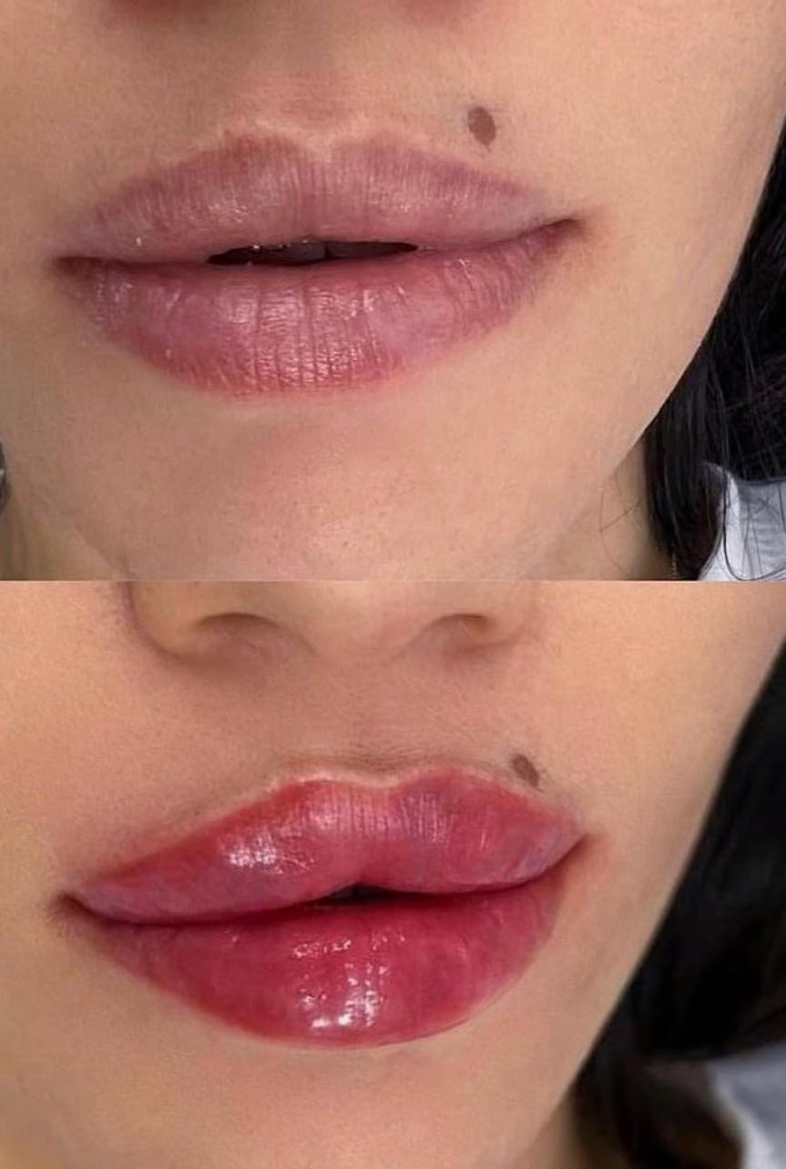 1.1ML Lip Filler