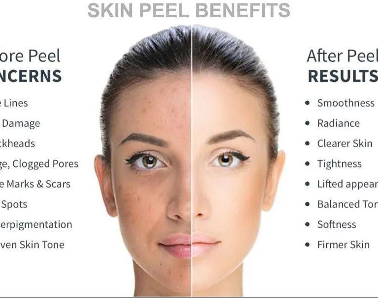 Facial Chemical Peel - from £70